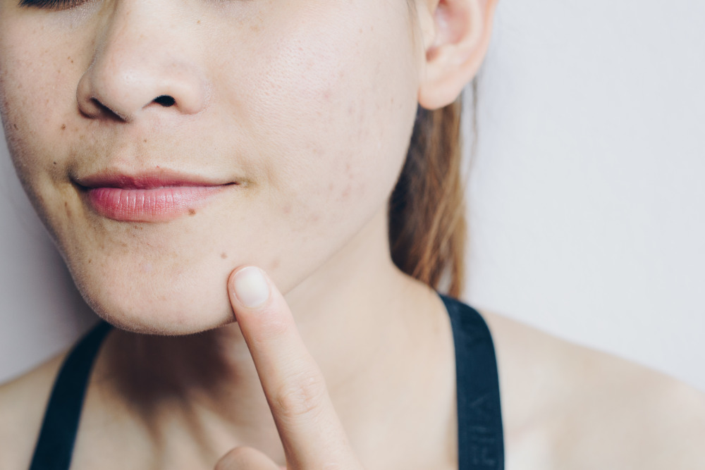 Close up of women's face pointing finger to facial acne scars.