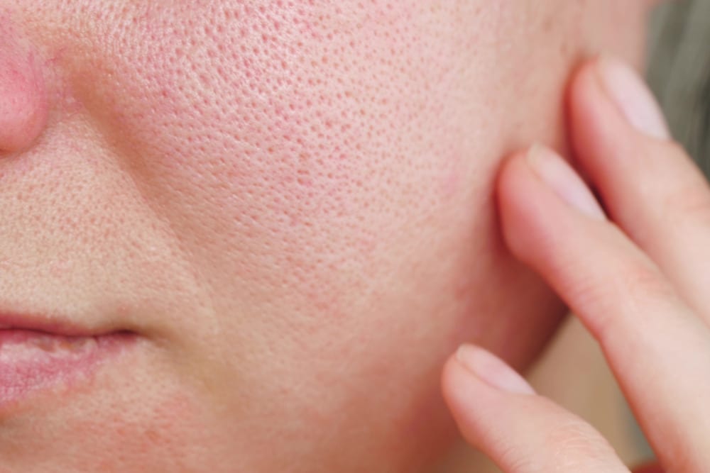 Close up view of woman touching her irritated red skin and enlarged pores with her fingers.